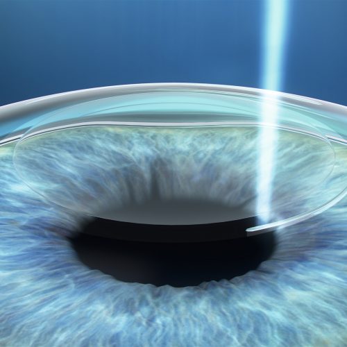 ZEISS Celebrates 1 Million SMILE Laser Vision Correction Procedures